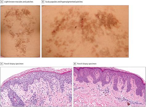 Reticular Hyperpigmented Eruption In A Young Woman Dermatology