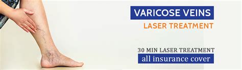 Varicose Veins Treatment Chirayu Healthcare Polyclinic And Diagnostics