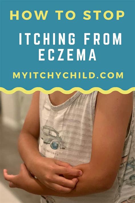 Pin On Eczema Remedies