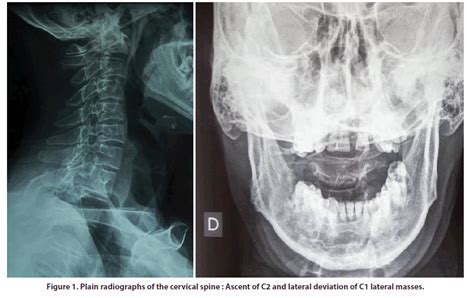 Occipital Neuralgia Reavealing An Atlantoaxial Subluxation In An