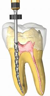 Pictures of Root Canal Treatment Procedure Pictures