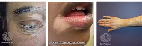 Tinea Versicolor Vs Vitiligo Whats The Difference Myvitiligoteam