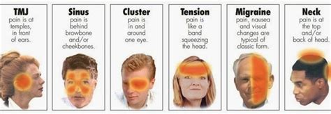 A Cure For Your Headaches And Migraines Pain Specialist Physiotherapist