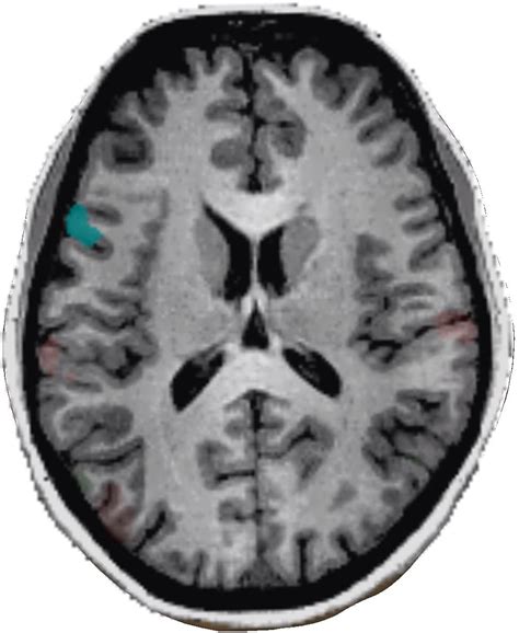 Broca S Area Is A Region In The Human Brain With Functions Linked To Speech Production Fmri