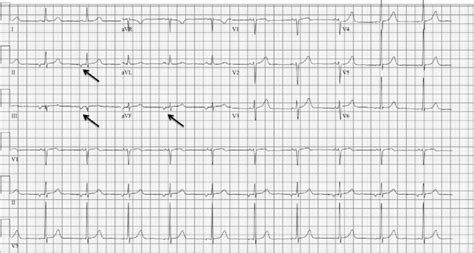 Ecg Shows An Ectopic Atrial Rhythm The Atrial Rate Is 63 Beatsmin And