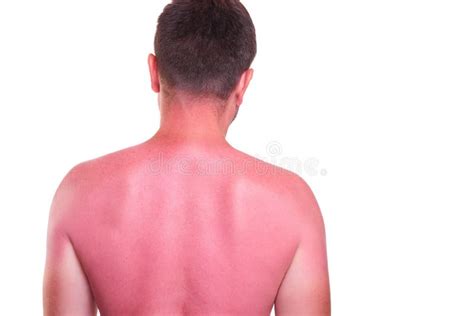 Man With Sunburnt Back On White Background Stock Photo Image Of