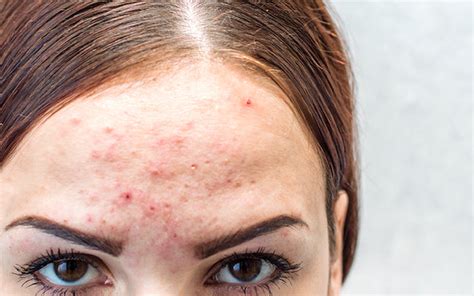 How To Treat Facial Acne Caused By Dandruff Skinkraft