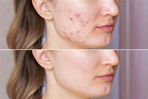 laser treatments for acne scars salcedo medical center and salcedo vein institute
