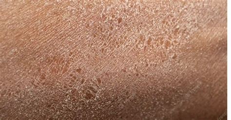 Dry Skin Causes And Effective Treatments