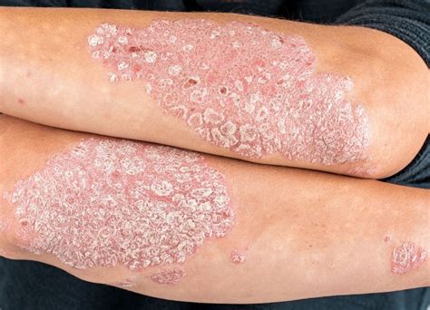 What Is Psoriasis What Are The Symptoms And Treatment Western