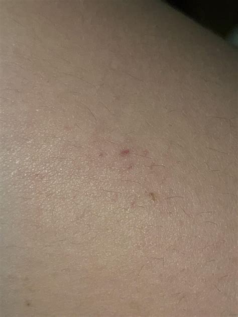 Red Dots On Lower Thigh No Cutsbumpspain Skincareaddicts