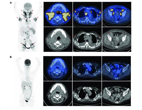 The Positron Emission Tomography Computed Tomography Pet Ct Scan At