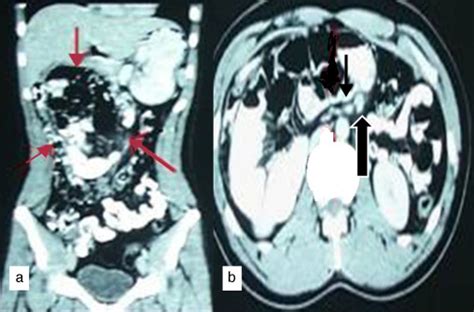 Contrast Enhanced Ct Abdomen A Coronal Reformat Shows Clustered