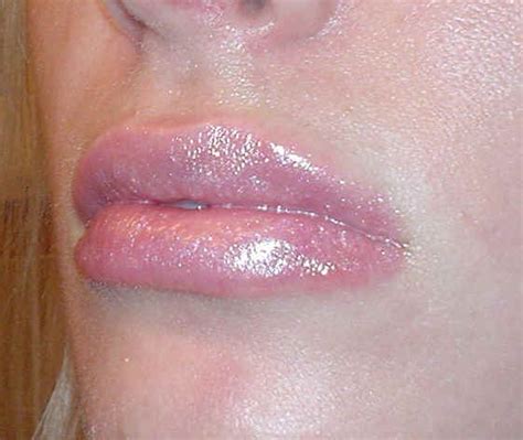 Lip Eczema Pictures Photos