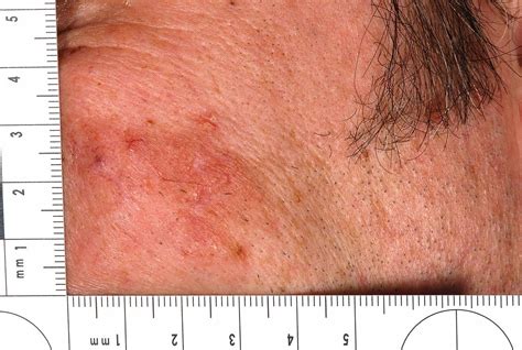 Curious Facial Plaque Diagnosed As Nodular Primary Localised Cutaneous