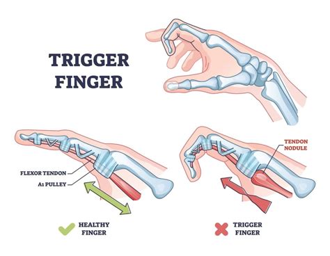 Trigger Finger Treatment Sydney Orthopaedic Surgeon
