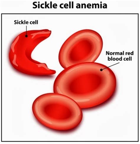 Signs and symptoms of sickle cell anemia. Sickle Cell Disease (Sickle Cell Anemia) Causes, Types ...