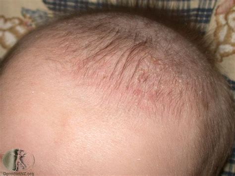 Seborrheic Dermatitis In Children Cradle Cap Dandruff