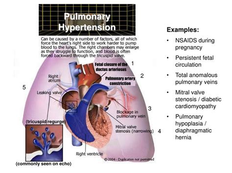 Persistent Pulmonary Hypertension Ati Template