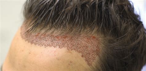 By and large, anybody with sound gums and teeth that are hoping. Can I Use Hair Fibres After Hair Transplant? | Clinicexpert