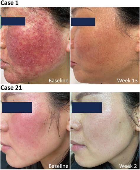 facial erythema of rosacea improved by tofacitinib treatment a download scientific diagram