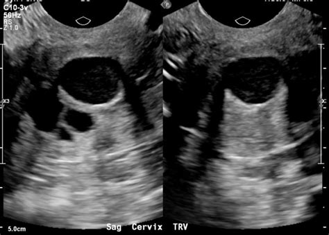 Cervix Nabothian Cysts Uterus