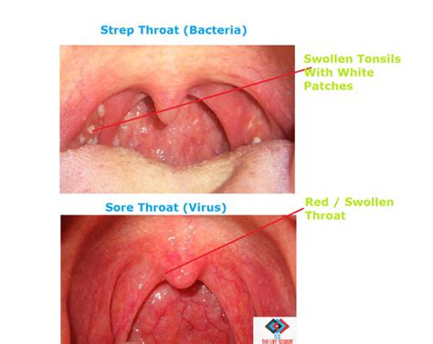 What Is Strep Throat And How Does It Differ From Common Sore Throat The Medic Shack