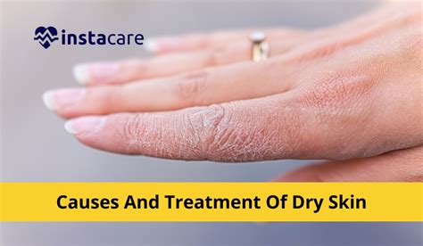 Causes And Treatment Of Dry Skin