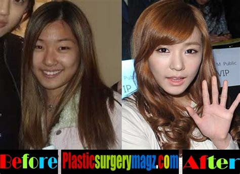 Tiffany Snsd Plastic Surgery Before And After Plastic Surgery Magazine