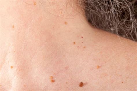 how to get rid of skin tags on neck