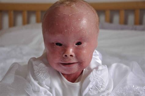 Harlequin Ichthyosis Causes Symptoms Diagnosis Survival And Treatment