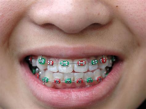 Metal Bracestraditional Braces Clear Choice Orthodontist