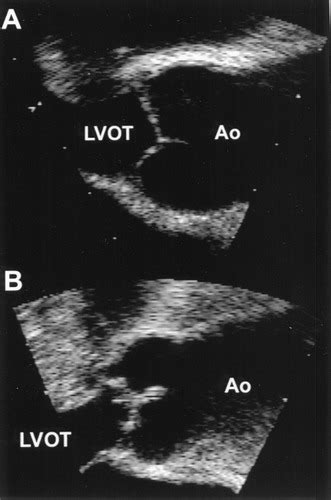 Aortic Valve Sclerosis And Aortic Atherosclerosis Different