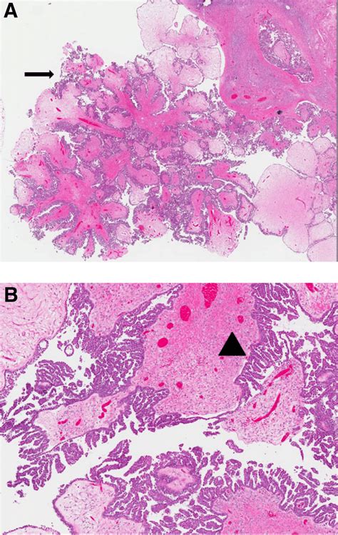 A B Serous Borderline Ovarian Carcinoma With Micropapillary Features