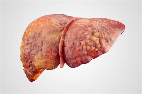 10 Natural Remedies That Help Prevent Liver Disease