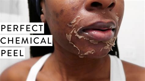 I Tried A Chemical Peel Full Process Before And After Dark Marks