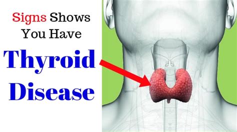 8 Common Symptoms Of Underactive Thyroid For Every One
