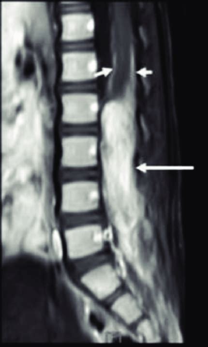 Contrast Enhanced Sagittal T1 Weighted Lumbosacral Mr Image Shows