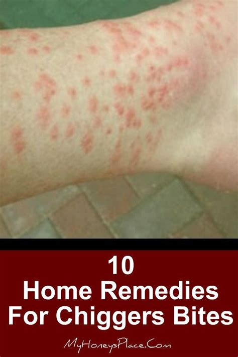 Pin On First Aid Home And Natural Remedies