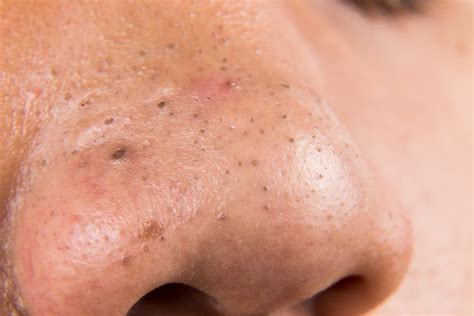 How To Remove Blackheads On Nose The Most Effective Ways