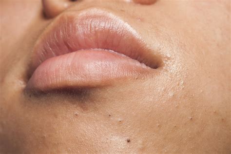 Clogged Pores Bumps On Chin Acne Symptoms