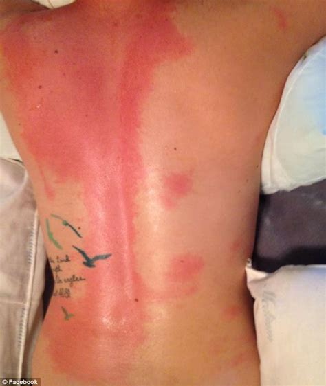 Woman 22 Reveals Horrific Burns She Suffered After Throwing Gallons