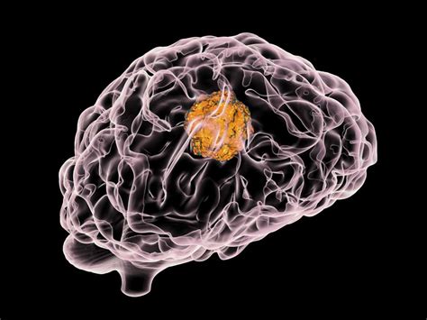 Glioblastoma A New Treatment For This Deadly Brain Tumor