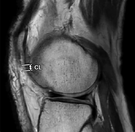 A Focal Defect At The Lateral Patellar Retinaculum On Clinical Knee Mri