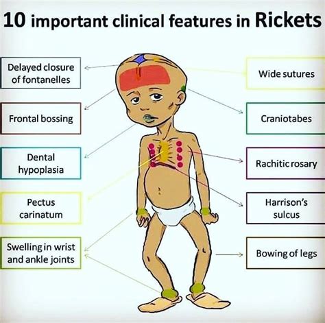 Read More And Download Book Immediately What Is Rickets Rickets Is A