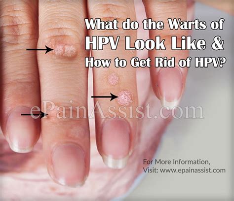 What Do The Warts Of Hpv Look Like And How To Get Rid Of Hpv