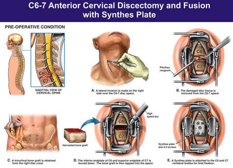 Cervical Radiculopathy Causes Symptoms Diagnosis And Treatment