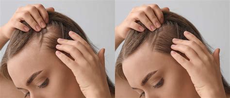 Hair Loss In Women Causes Treatment And Prevention