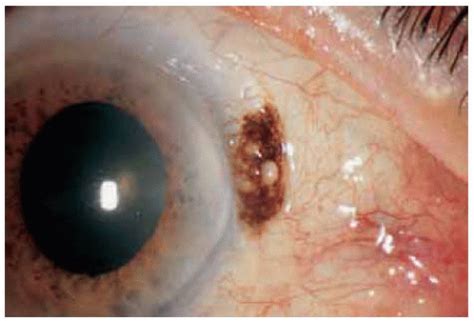 Conjunctiva Melanocytic Lesions Ento Key