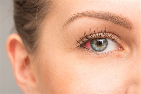 Red Spots In The Eye Causes Diagnosis And Treatment